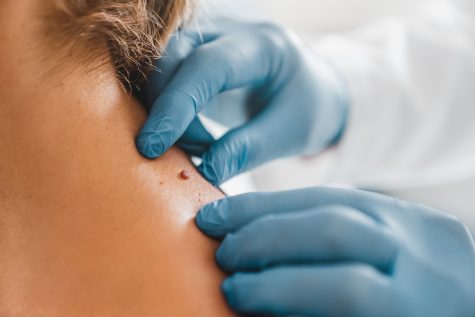 Guest Opinion | The Doctor is in: Relearning your ABCDEs can help diagnose melanoma